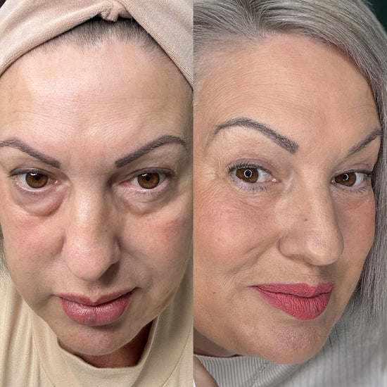 The LeStrova Radiance Lift