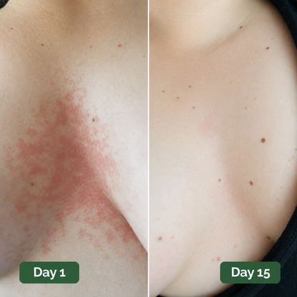 Lestrova Antifungal Boob Itch Soap