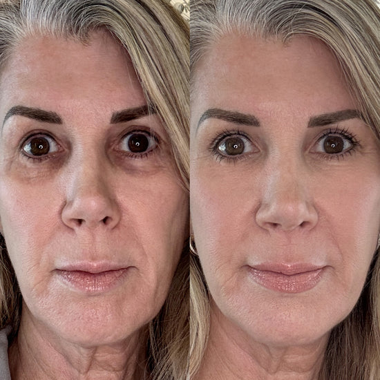 The LeStrova Radiance Lift