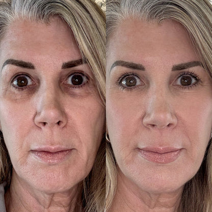 The LeStrova Radiance Lift