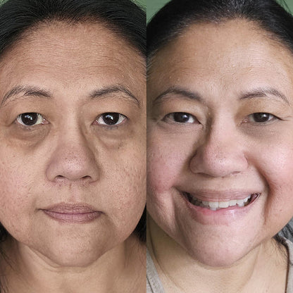 The LeStrova Radiance Lift